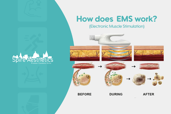 EMS treatment for post pregnancy weight loss treatment Port Glasgow