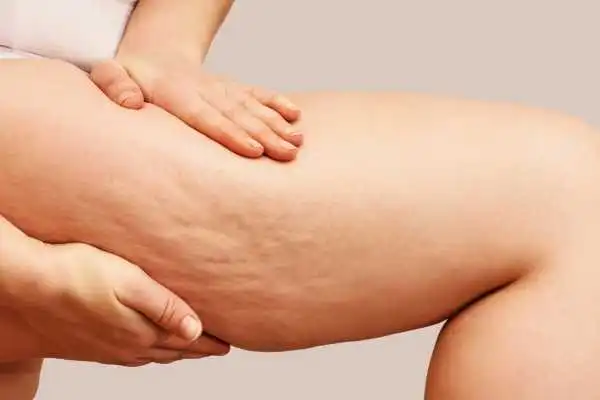 Image of woman showing leg with cellulite Port Glasgow