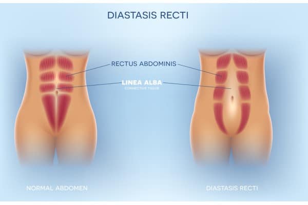 What Non-Surgical Options Are Available for Diastasis Recti Port Glasgow?