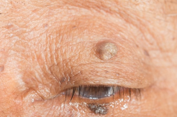 Skin imperfections Port Glasgow - Cryopen is fast and effective book in today!