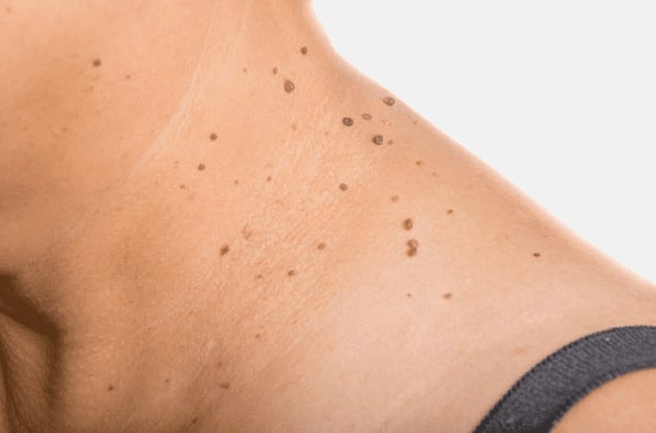 Are you looking for easy skin tag removal Port Glasgow - then contact Spire today!