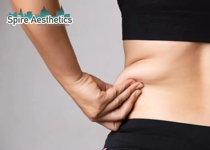 Image of woman pinching fat on their hips Port Glasgow. Fat Freezing treatment 