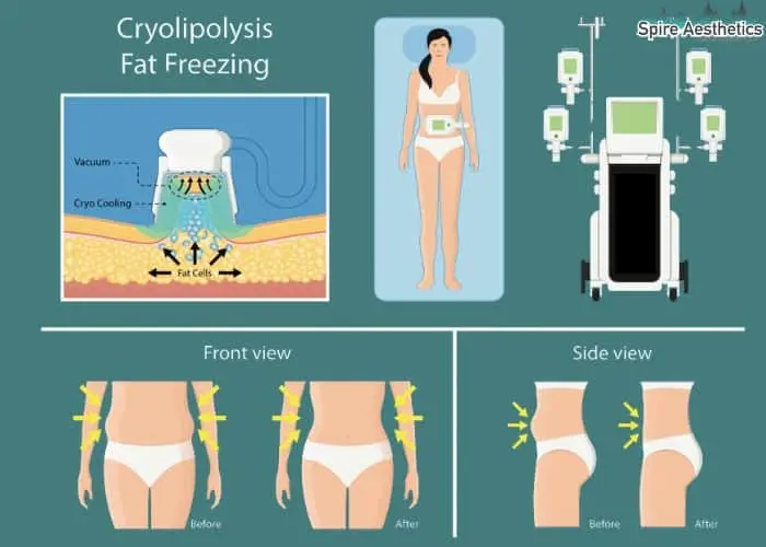 Fat freezing treatment Port Glasgow benefits for competitions to remove stubborn fat deposits.
