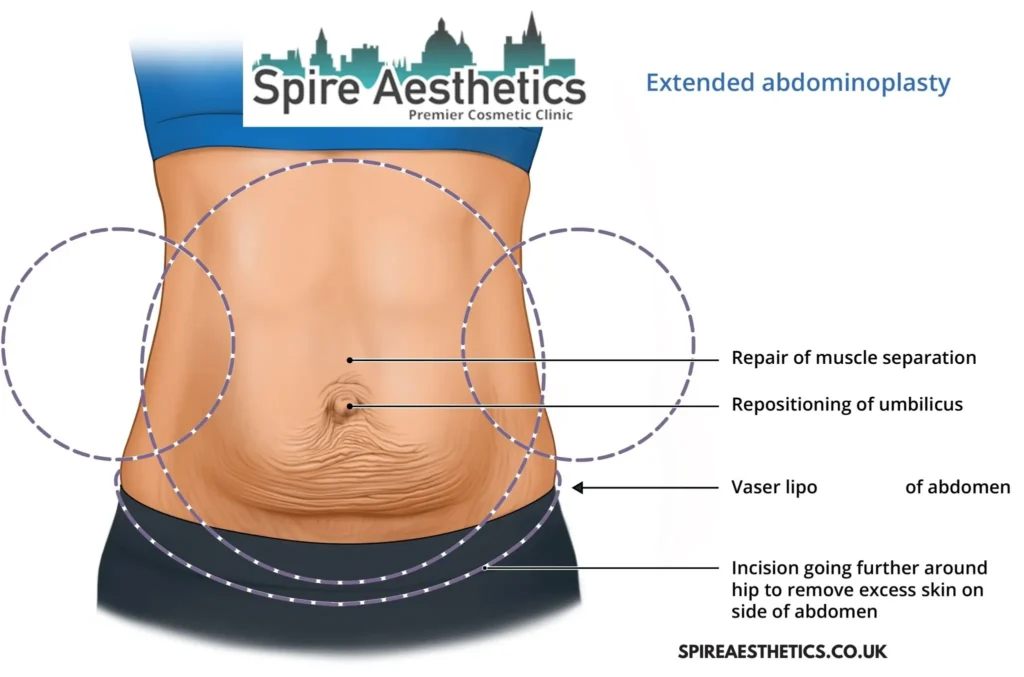 Understanding Loose Skin After Gastric Band Port Glasgow Surgery and HIFU Treatment 