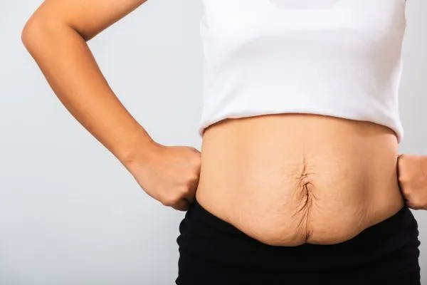 Image of a woman's stomach after weight loss with sagging skin following a gastric band Port Glasgow