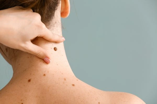 skin blemish removal Port Glasgow treatment