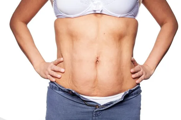 sagging skin on woman's stomach after weight loss injections Port Glasgow