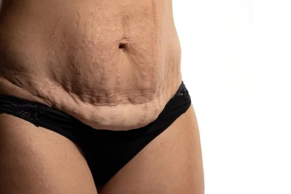 Image of womans stomach after weight loss injections Port Glasgow showing saggy skin