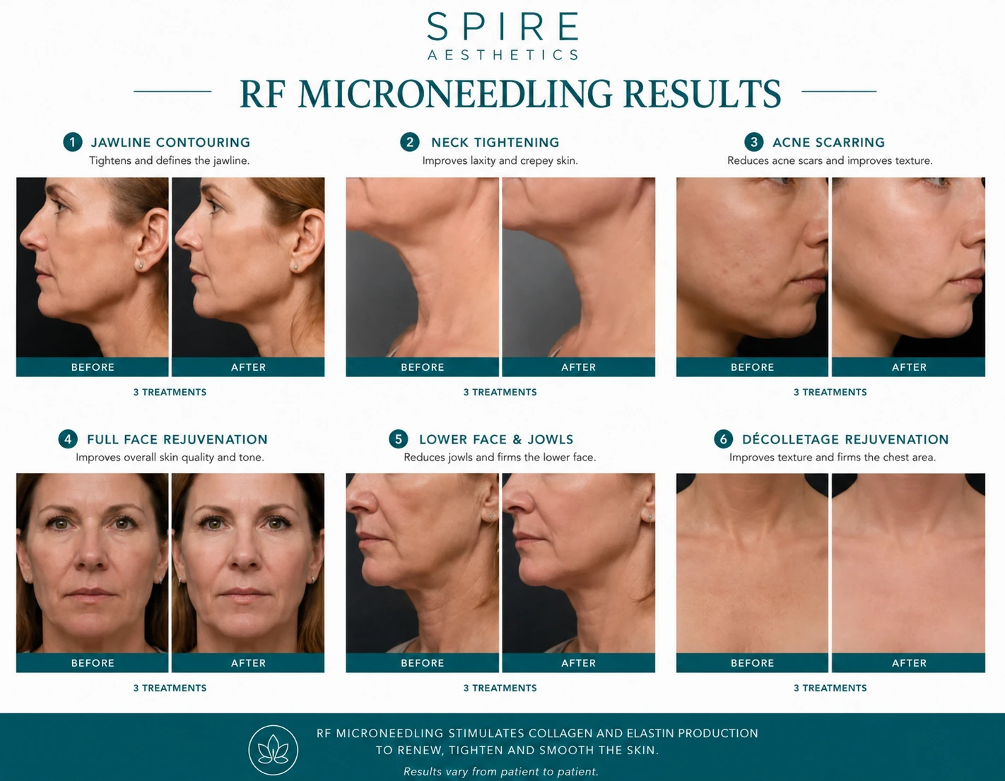 RF Microneedling Skin tightening Port Glasgow results