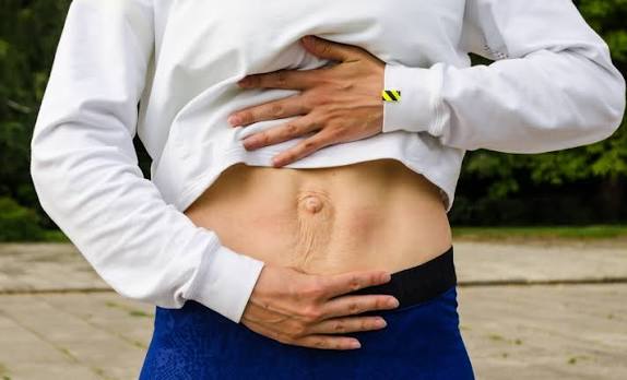 When Could Diastasis Recti Be the Missing Piece of the Puzzle Port Glasgow?