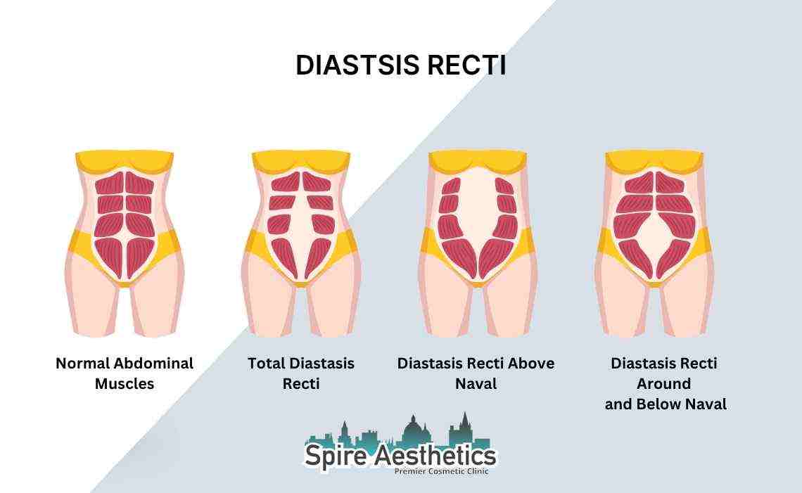 Is Non-Surgical Diastasis Recti Treatment Right for You? Common Concerns Answered Port Glasgow